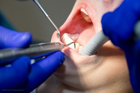 Professionelle Zahnreinigung Bild 1