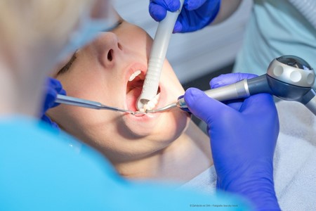 Professionelle Zahnreinigung Bild 2